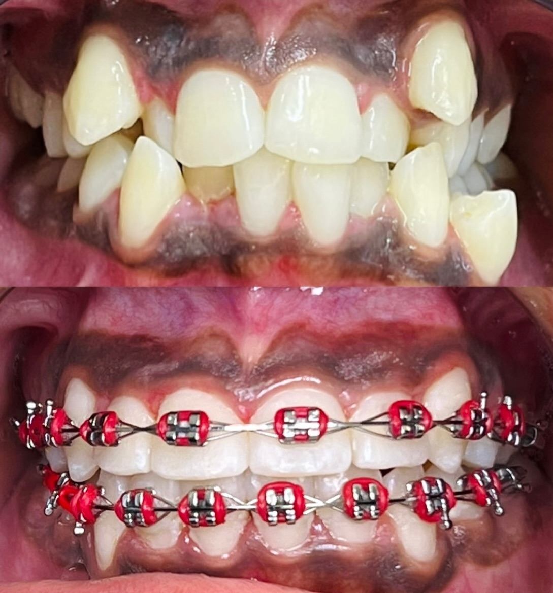 Braces transformation 10